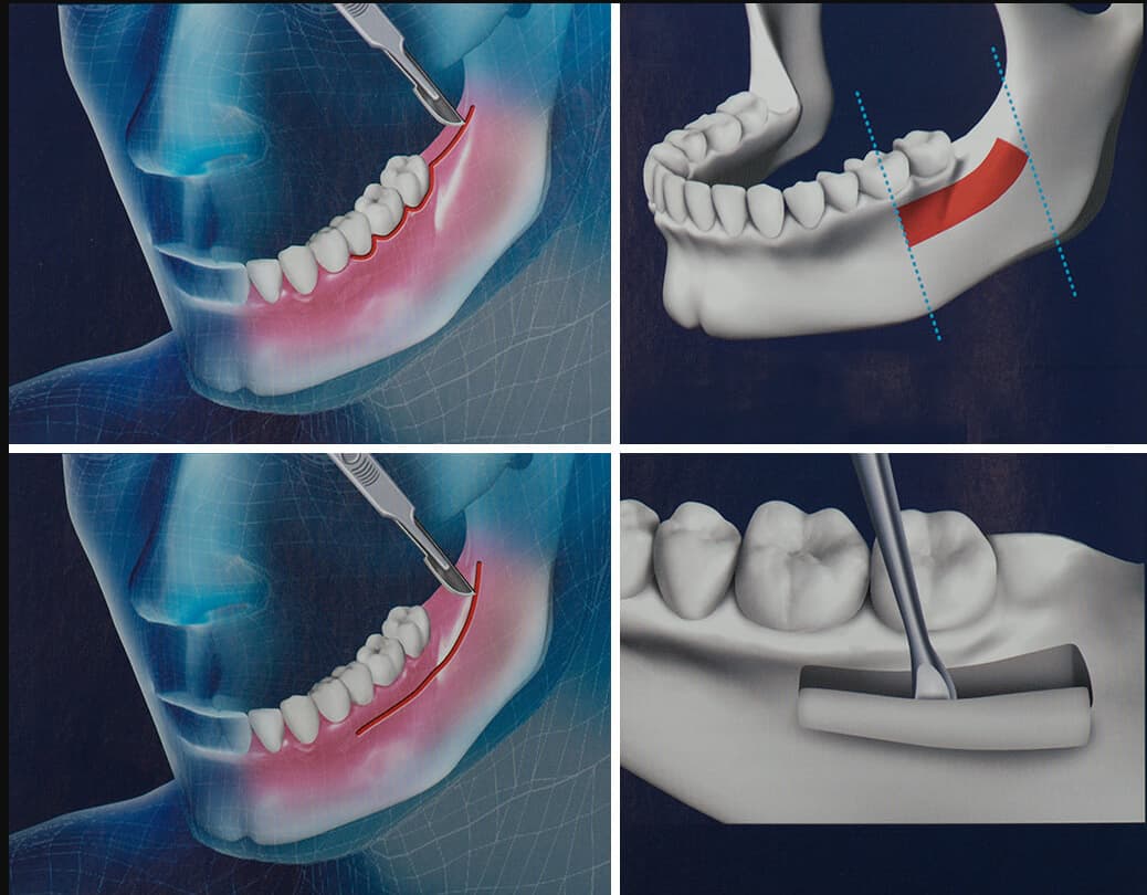 Восстановление костной ткани зубов. Синус-лифтинг (костная пластика, остеопластика). Остеопластика и синус лифтинг. Остеопластика нижней челюсти.